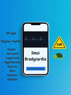 E C G  R H Y T H M S 🫀 The heart! It’s like a drummer, keeping the beat going. But sometimes, the rhythm gets a little funky. Let’s dive into some common heart rhythms: Normal Sinus Rhythm (NSR) The heart’s “happy dance”! A normal heartbeat, around 60-100 beats per minute (bpm). Think of it like a steady disco beat. Sinus Bradycardia The heart’s “chill vibe” rhythm! Slower than normal, usually below 60 bpm. Think of it like a relaxing reggae tune. Sinus Tachycardia The heart’s “running late” rhythm! Faster than normal, usually above 100 bpm. Atrial Flutter The heart’s “fluttering butterfly” rhythm! A fast, regular rhythm, usually around 200-400 bpm. Picture a hummingbird’s wings flapping rapidly. Atrial Fibrillation (AFib) The heart’s “chaotic dance party” rhythm! A fast, irregular rhythm, like a playlist on shuffle. It’s like the heart is saying, “I’m going to beat to my own drum... randomly!” That’s a quick rundown of these heart rhythms! Now, go forth and impress your friends with your newfound cardiac knowledge🤓 #ecg #ekg #ekginterpretation #ecginterpretation #ecgstrips #ems #emt #paramedic #firefighter #nurse #nurses #medstudent #medic #doctor #flightmedic #ernurse #ertech #greysanatomy #medsurg #nursing #emtschool #paramedicschool #needles #medicalassistant #healthcare #healthcareworker #registerednurse #icu 