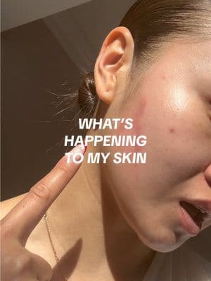 And why is it mainly on the sides of my face? I haven’t changed my skin routine at all so I’m thinking it might be something I’m eating?  #skinissues #skinproblems #skinproblem #dermatologistneeded #helpmeout #skinthoughts #allergicreaction #allergicreactioncheck #skinreaction #skincare 