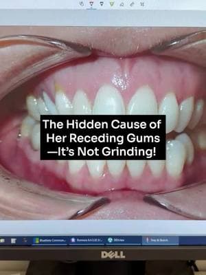 She thought an old root canal was the problem… but the real issue was hiding in plain sight! Her tight tongue tie caused years of damage—leading to gum recession, cavities, and misaligned teeth. A mouth guard wouldn’t have helped—in fact, it would have made things worse! Instead, we’re expanding her smile with clear aligners to give her tongue the space it needs. Have you ever been told you grind your teeth? It might not be what you think! #HealthySmile #TongueTie #GumRecession #MouthHealth #grinding #recedinggums