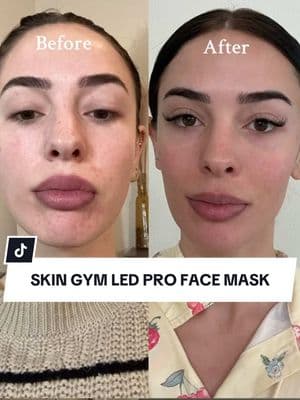 Is this Skin Gym LED Pro Mask worth it?! Check out my before and after cause I’m OBSESSED @skingym ✨🤍🧖🏻‍♀️ #skingym #ledfacemask #ledmasktherapy #led #skincare #skincareroutine #skincaretips 