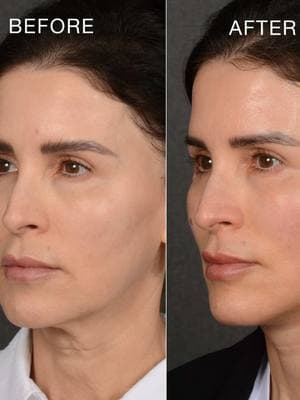 ✨ Jawline goals unlocked! ✨ Watch how a subtle transformation smooths out jowls and sculpts a natural, youthful jawline. Want to know the secret? 🤫 It’s all about enhancing your features without going overboard.  Neck lift, mini facelift, or full facelift—what do you think was done here? Drop your guesses and questions below! 👀 ⬇️  #JawlineSculpt #NaturalBeauty #FaceliftVsMiniFacelift #RejuvenationGoals #YouthfulLook #NeckLiftResults #AgelessAesthetic #AntiAgingSecrets #DrRahban #transformationthursday #BeautyTransformation #SkincareJourney #TikTokBeautyTips #FacialRejuvenation