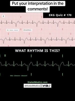 ⚠️🫀🤔 All #EKG recordings are from the EKG rhythm generator on my website (LII rhythms only for now, 12Ls are in beta and coming soon), be sure to check it out for more software generated #ECG practice! (Link in bio.) #EMS #ACLS #emstok #paramedic #paramedicsoftiktok #medic #medicsoftiktok #flightmedic #criticalcareparamedic #paramedicstudent #paramedicschool #emta #emtb #emt #emtlife #emtsoftiktok #emtstudent #emtschool #firstresponders #NREMT #nurse #nursesoftiktok #RN #nursingstudent #nursingschool #flightnurse #criticalcarenurse #emergencynurse #NCLEX #nclexrn #nclexprep #doctor #doctorsoftiktok #medicalstudent #USMLE #emergencymedicine #criticalcare #cardiology #foamed 