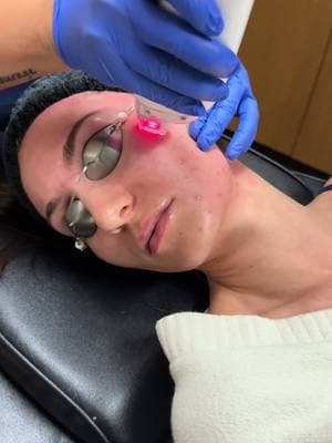 Lutronic Ultra laser @JohnsonDermatology my before and after are INSANE! New fresh skin. Pigmentation gone. That was only one treatment can’t wait to see what 3 does #lutronic #lutronicultralaser #skinlasertreatment #hormonalacnejourney #hormonalacne 