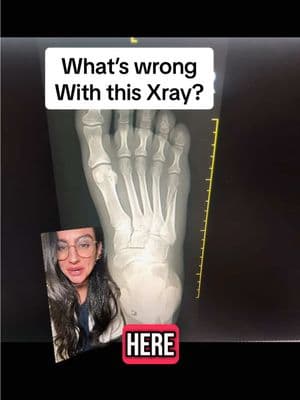 What’s wrong with this X-ray?! #fracture #footfracture #edutok #tiktokdoc #podiatry #education #educate #bone #foot 