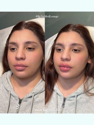 Lip filler love 💋 Enhanced this patient’s beautiful lips with more volume, height and hydration. Results are a plump and refreshed pout. Call us today to elevate your lips: 📱818-308-7274 📍Studio City, CA #perfectpout #lipfiller #lipinspo #lipcare #beforeandafter #cosmeticinjector #injector #beauty #aestheticPA 